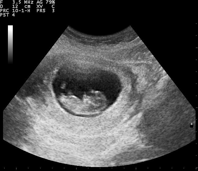 Ultrasound image of a foetus in the womb. © Nevit Dilmen (CC BY-SA 3.0).